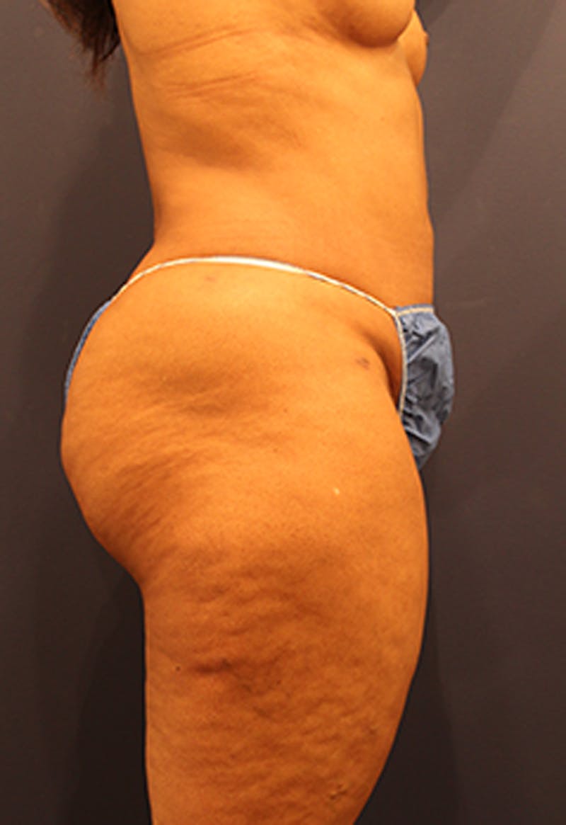 Liposuction Before & After Gallery - Patient 174164449 - Image 8
