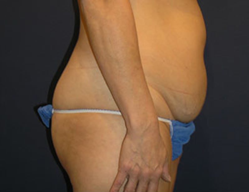 Liposuction Before & After Gallery - Patient 174164452 - Image 1
