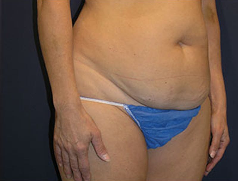 Liposuction Before & After Gallery - Patient 174164452 - Image 3