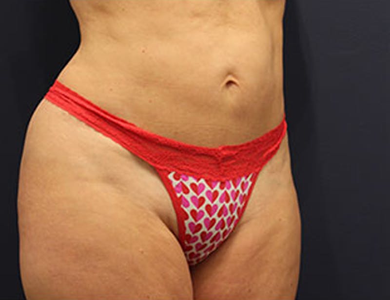 Liposuction Before & After Gallery - Patient 174164452 - Image 4