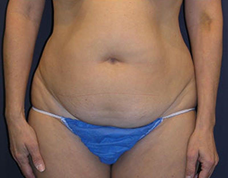 Liposuction Before & After Gallery - Patient 174164452 - Image 5