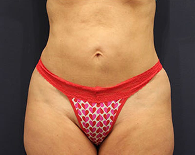 Liposuction Before & After Gallery - Patient 174164452 - Image 6