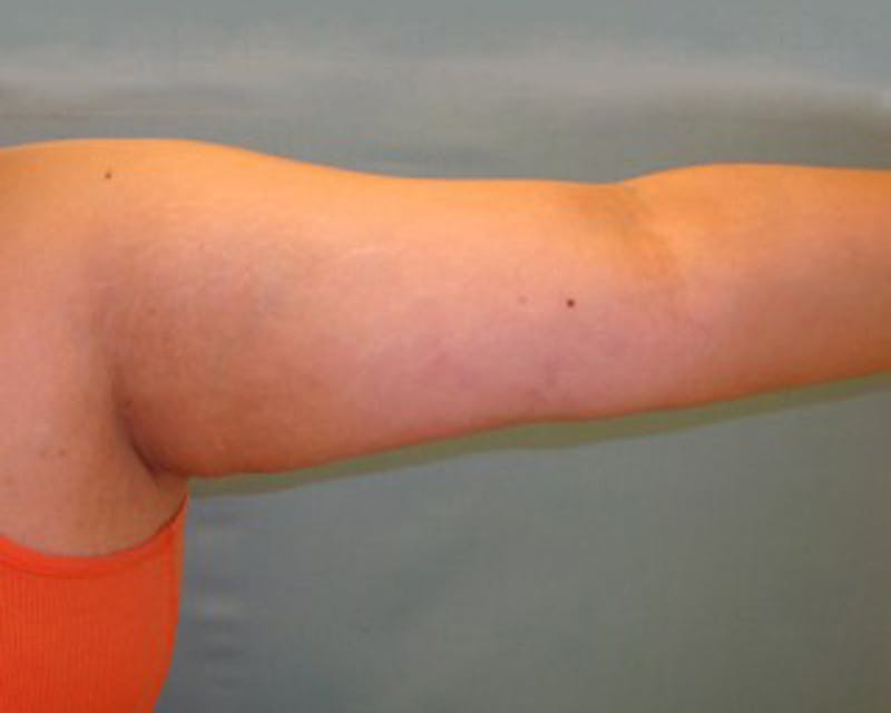 Liposuction Before & After Gallery - Patient 174164462 - Image 2