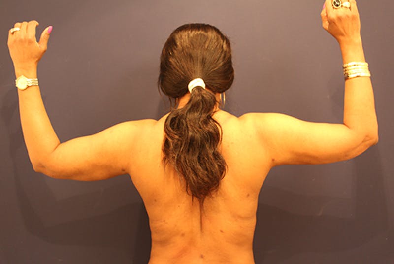Liposuction Before & After Gallery - Patient 174164468 - Image 4