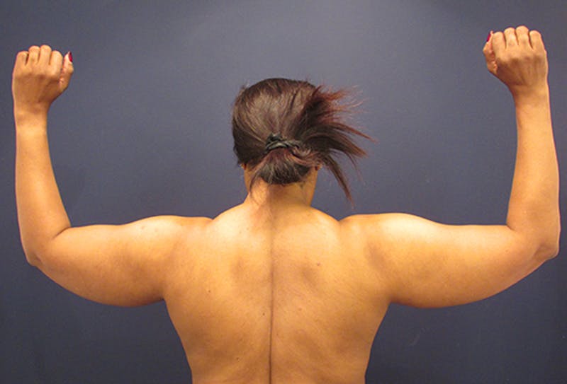 Liposuction Before & After Gallery - Patient 174164468 - Image 3