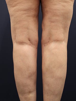 Liposuction Before & After Gallery - Patient 174164471 - Image 6