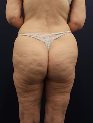 Liposuction Before & After Gallery - Patient 174164471 - Image 4