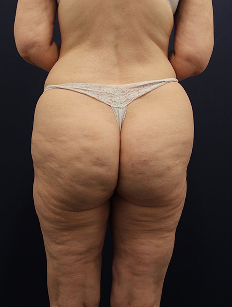 Liposuction Before & After Gallery - Patient 174164471 - Image 4