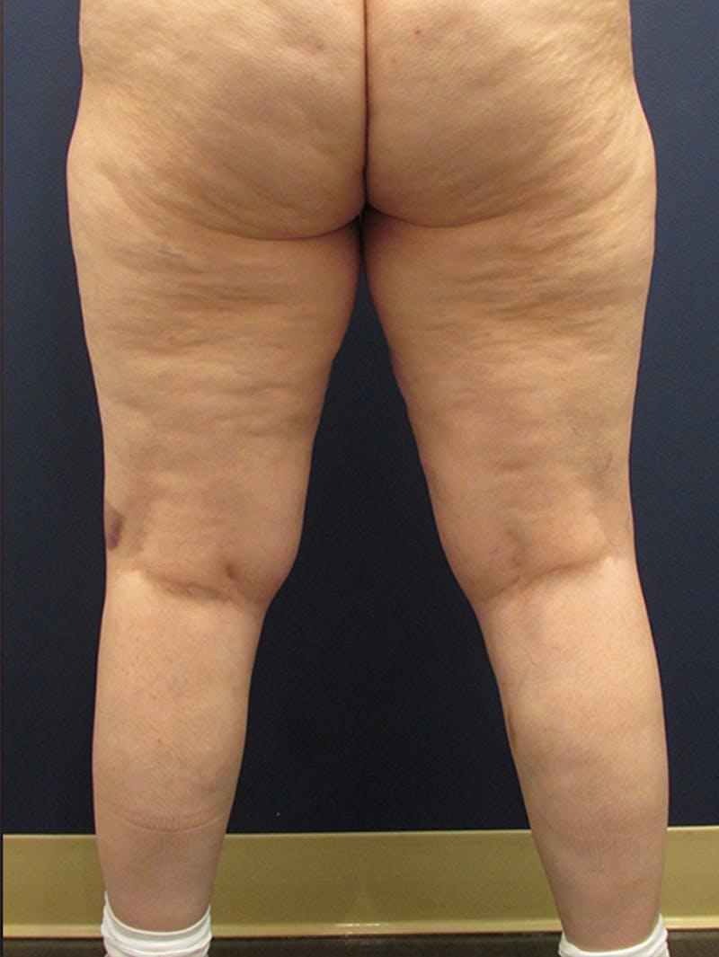 Liposuction Before & After Gallery - Patient 174164471 - Image 5