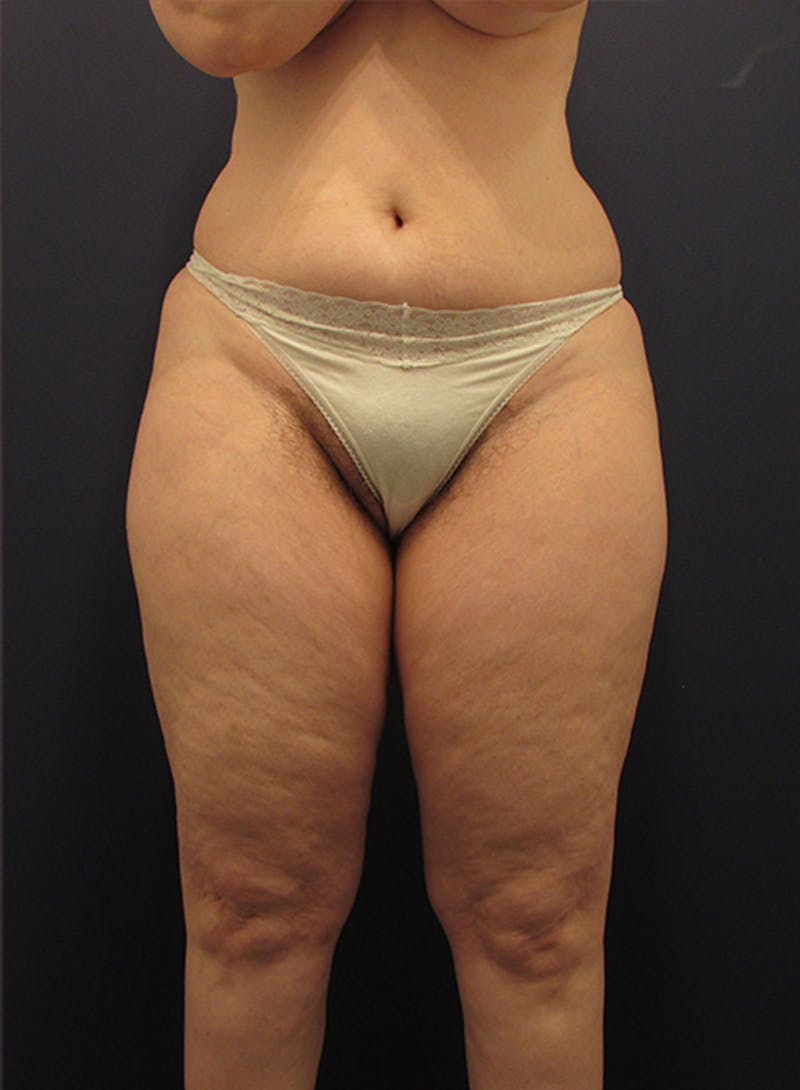 Liposuction Before & After Gallery - Patient 174164471 - Image 1