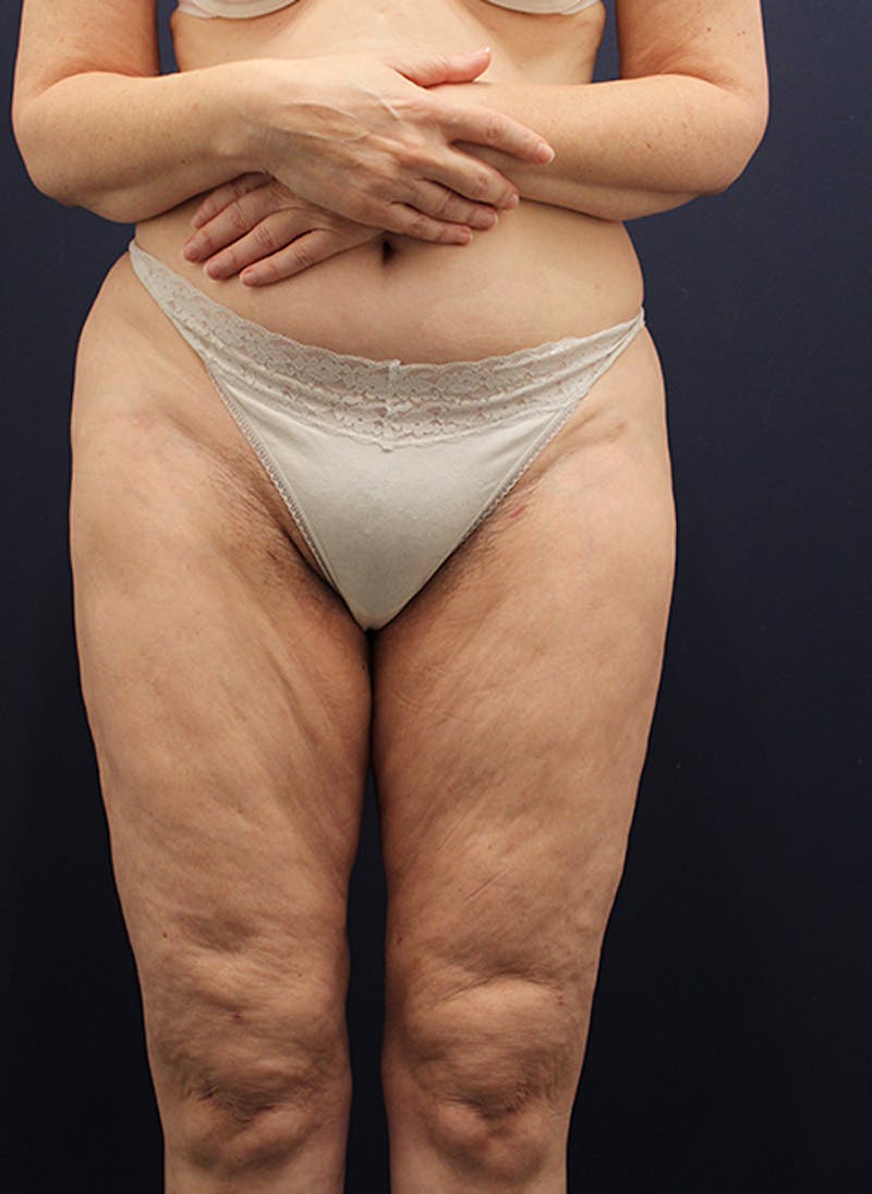 Liposuction Before & After Gallery - Patient 174164471 - Image 2