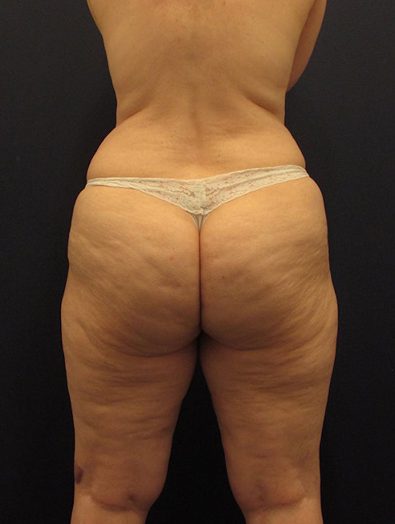 Liposuction Before & After Gallery - Patient 174164471 - Image 3
