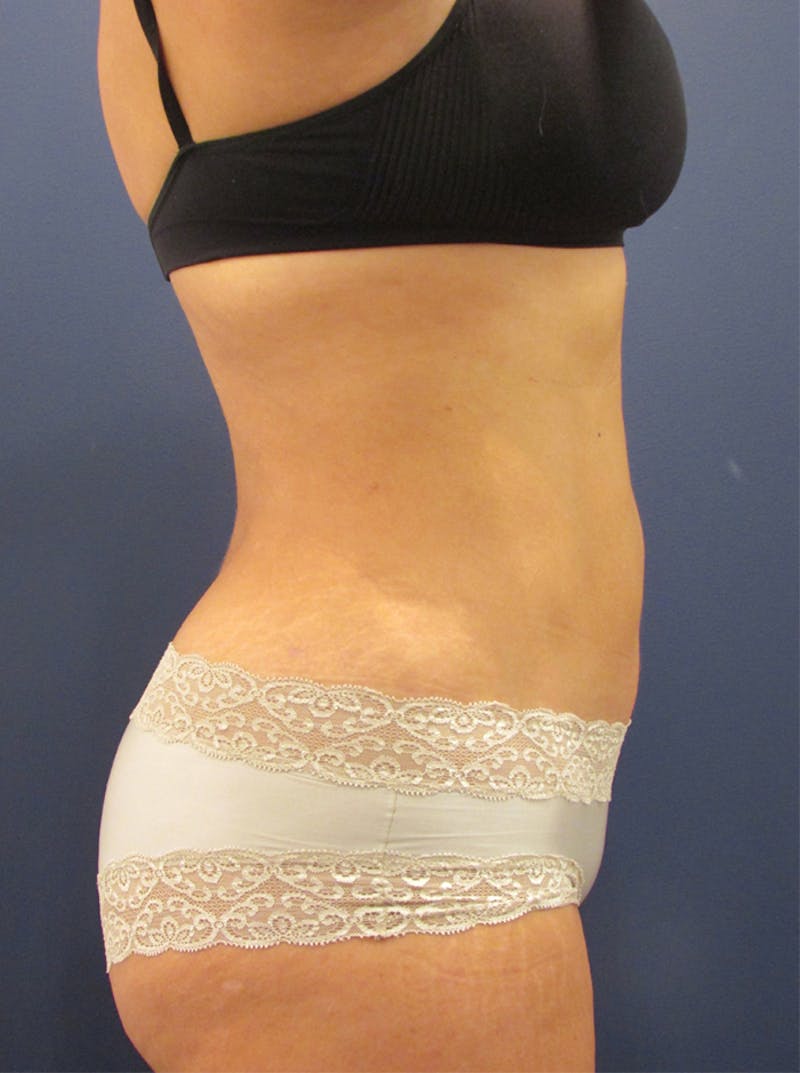 Liposuction Before & After Gallery - Patient 174164482 - Image 6