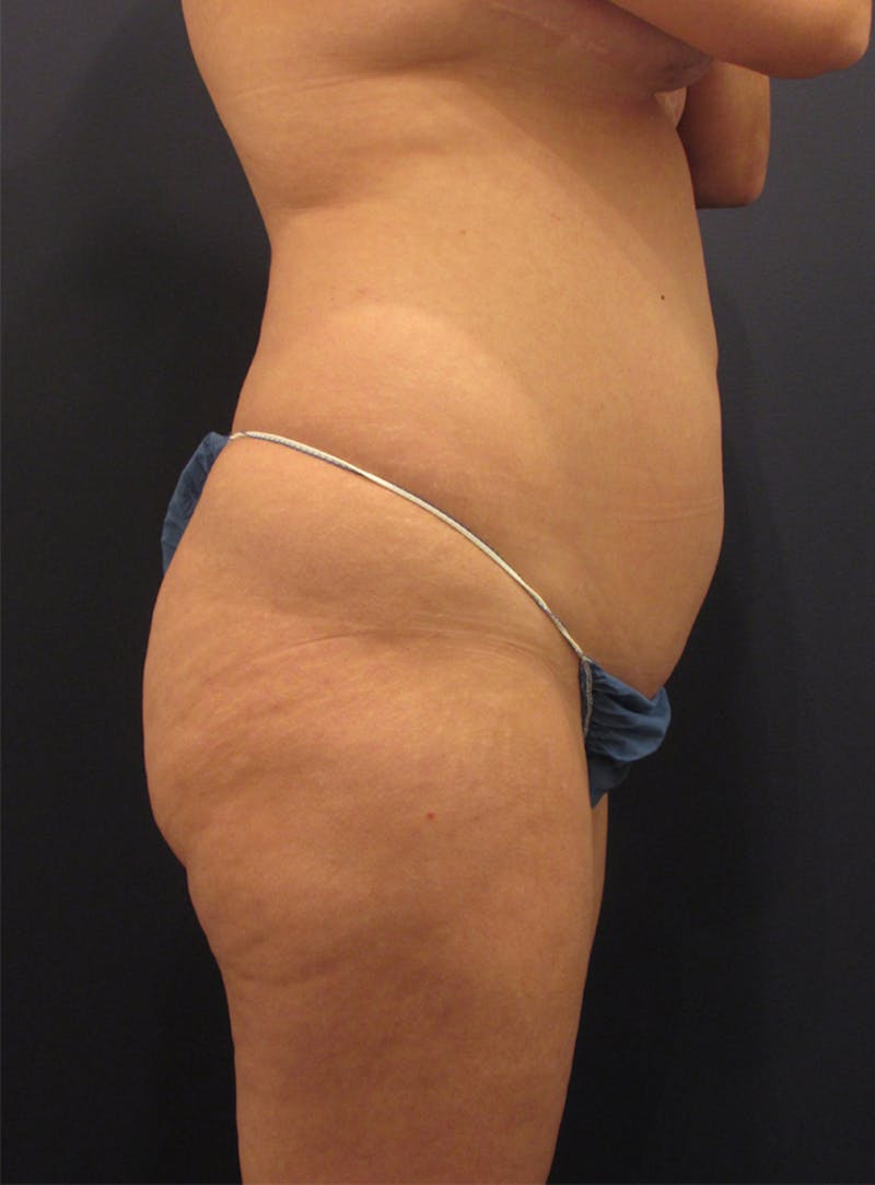 Liposuction Before & After Gallery - Patient 174164482 - Image 5