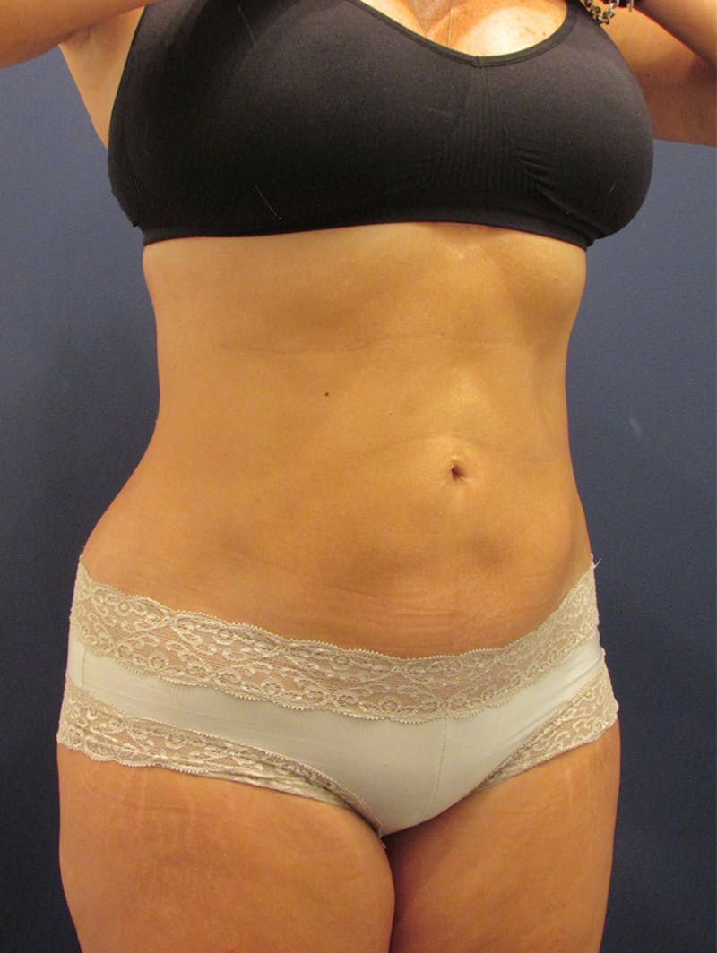 Liposuction Before & After Gallery - Patient 174164482 - Image 4