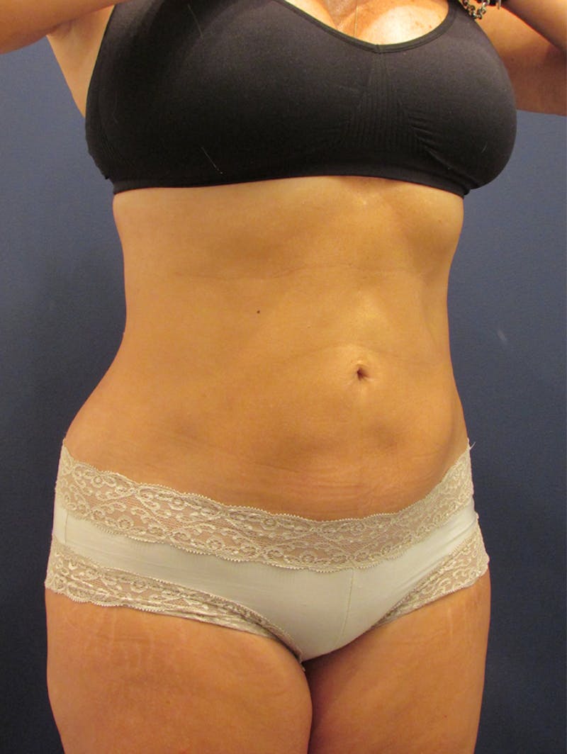 Liposuction Before & After Gallery - Patient 174164482 - Image 4