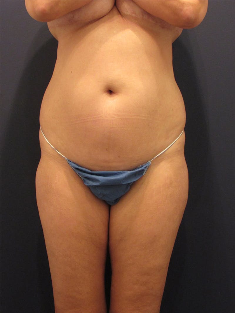 Liposuction Before & After Gallery - Patient 174164482 - Image 1