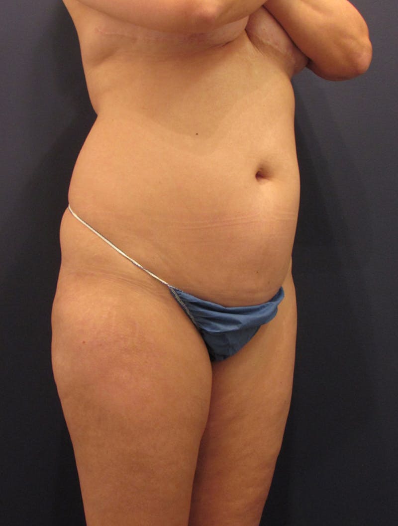 Liposuction Before & After Gallery - Patient 174164482 - Image 3