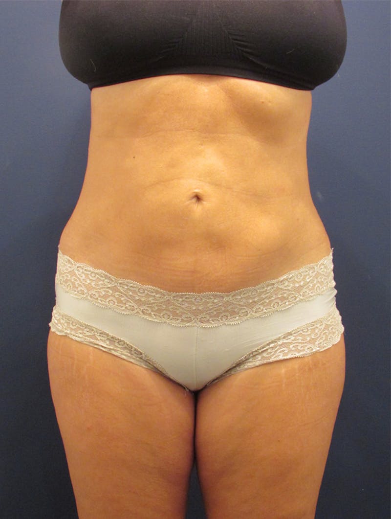 Liposuction Before & After Gallery - Patient 174164482 - Image 2