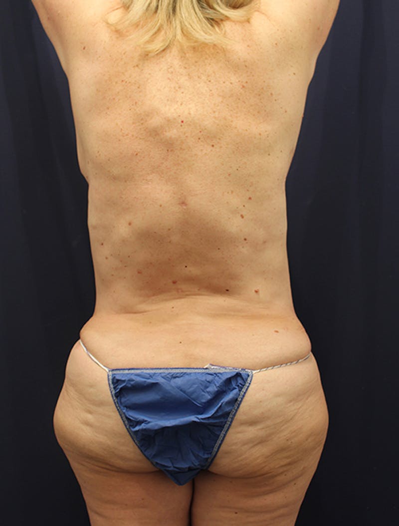 Liposuction Before & After Gallery - Patient 174164492 - Image 4