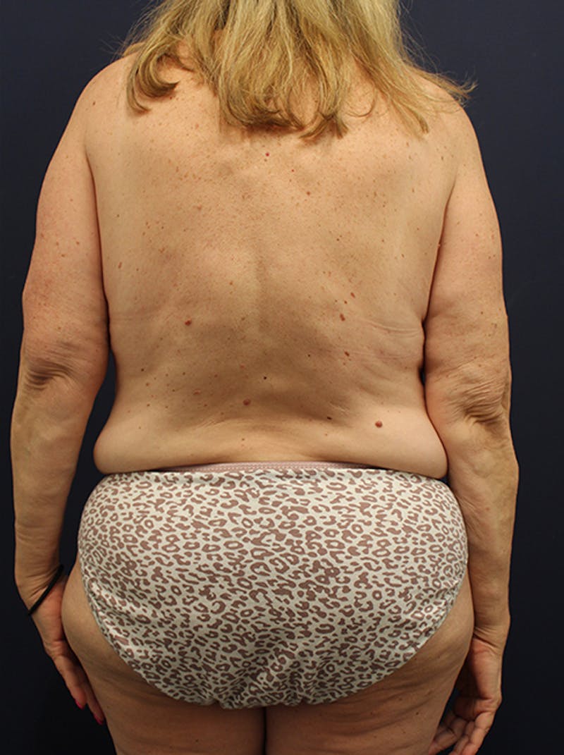 Liposuction Before & After Gallery - Patient 174164492 - Image 1