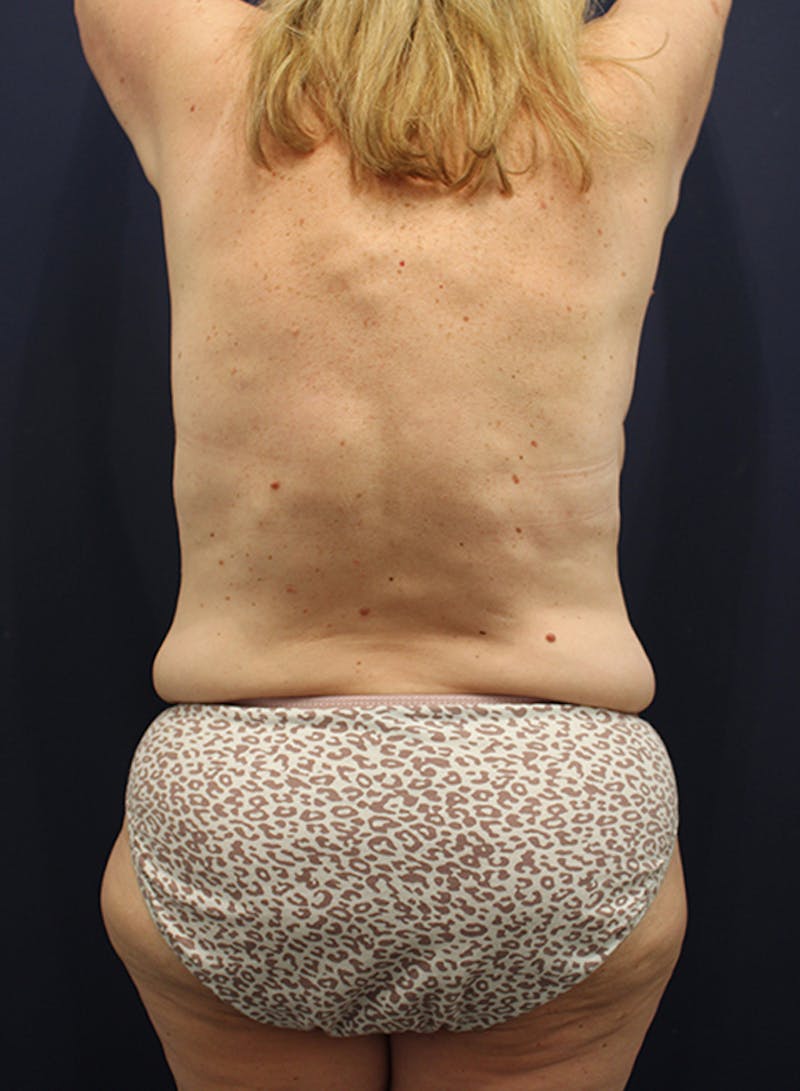 Liposuction Before & After Gallery - Patient 174164492 - Image 3