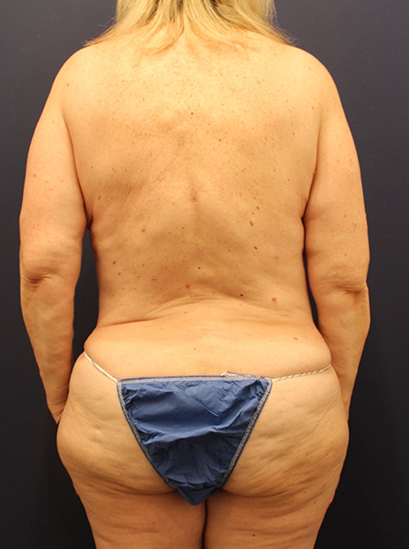Liposuction Before & After Gallery - Patient 174164492 - Image 2