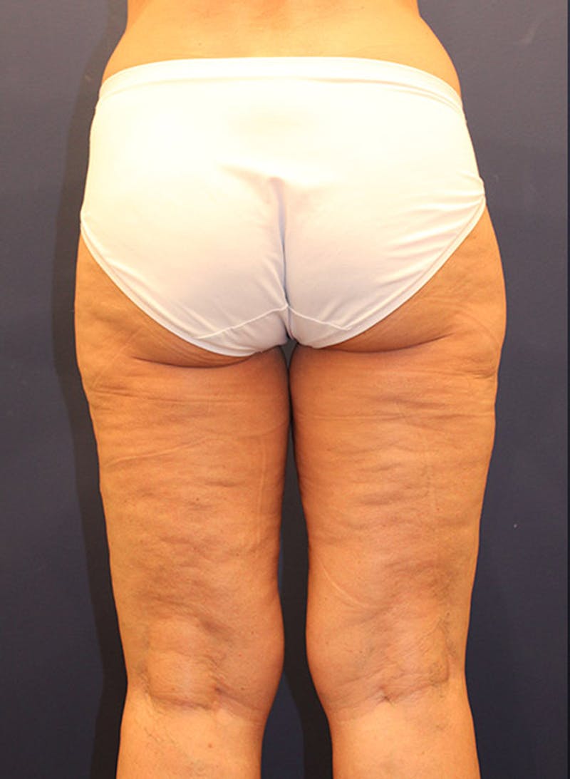 Liposuction Before & After Gallery - Patient 174164496 - Image 4