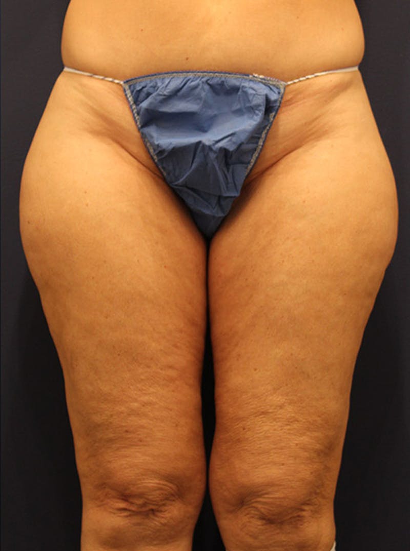 Liposuction Before & After Gallery - Patient 174164496 - Image 1