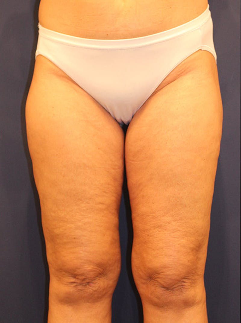 Liposuction Before & After Gallery - Patient 174164496 - Image 2