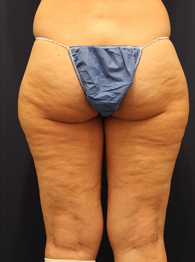 Liposuction Before & After Gallery - Patient 174164496 - Image 3