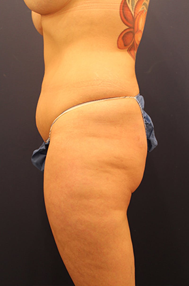 Liposuction Before & After Gallery - Patient 174164503 - Image 5