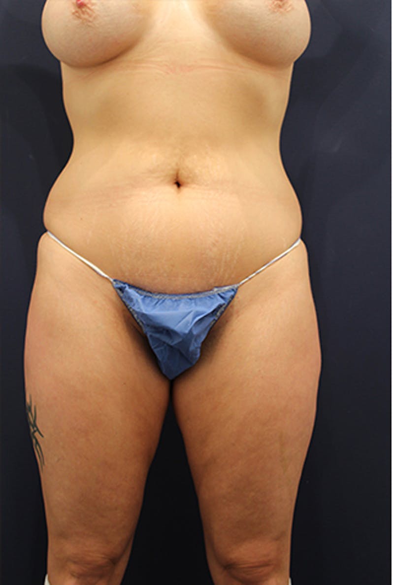 Liposuction Before & After Gallery - Patient 174164503 - Image 1
