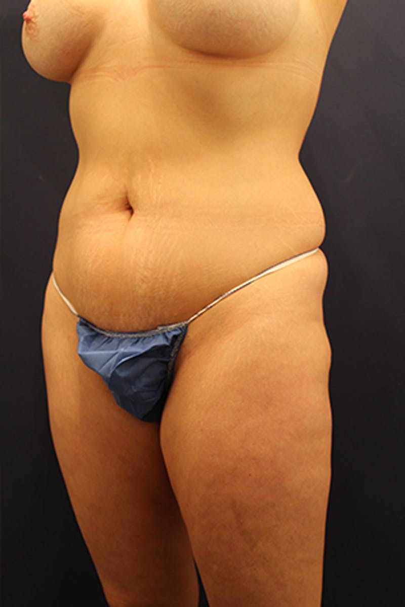 Liposuction Before & After Gallery - Patient 174164503 - Image 3
