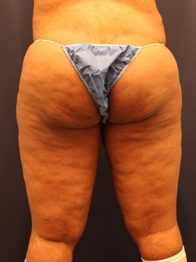 Liposuction Before & After Gallery - Patient 174164507 - Image 5