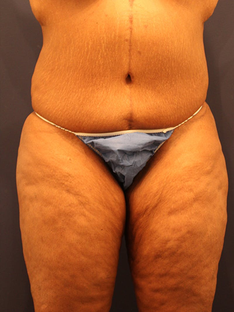 Liposuction Before & After Gallery - Patient 174164507 - Image 1