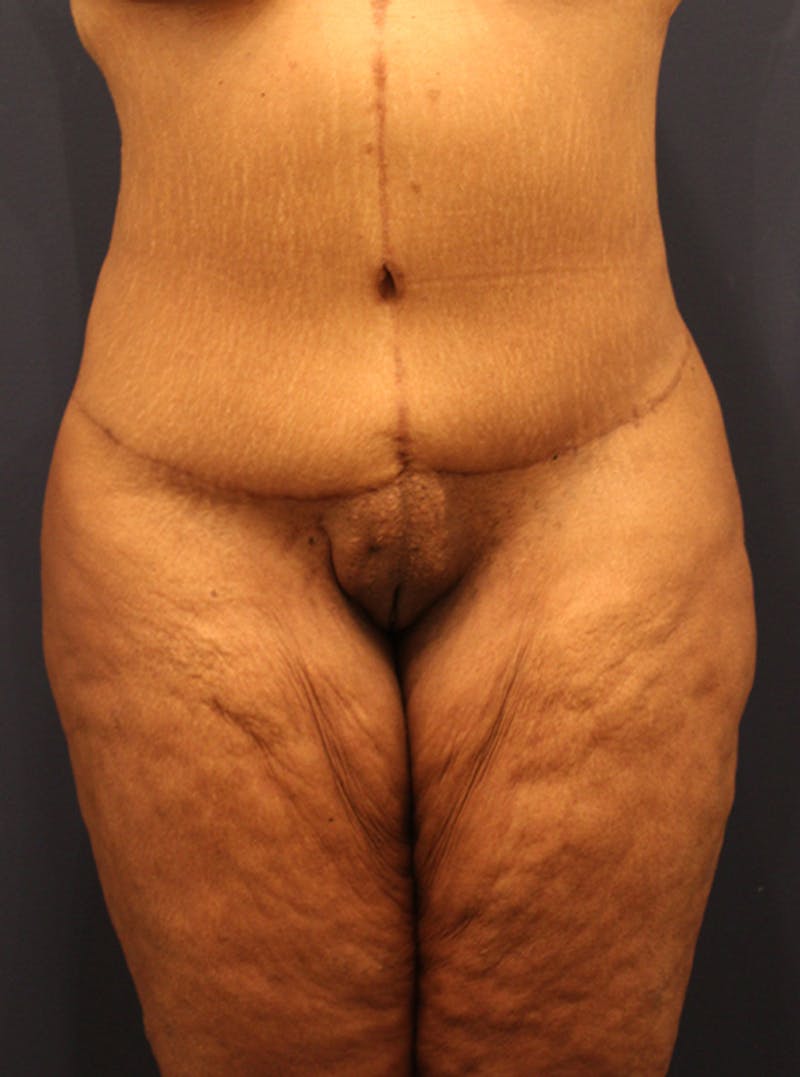 Liposuction Before & After Gallery - Patient 174164507 - Image 2