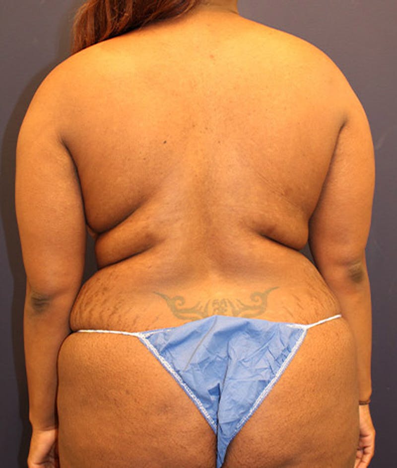 Liposuction Before & After Gallery - Patient 174164509 - Image 1