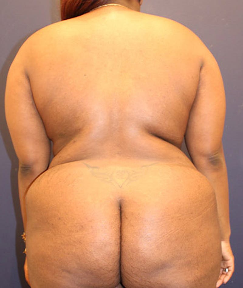 Liposuction Before & After Gallery - Patient 174164509 - Image 2