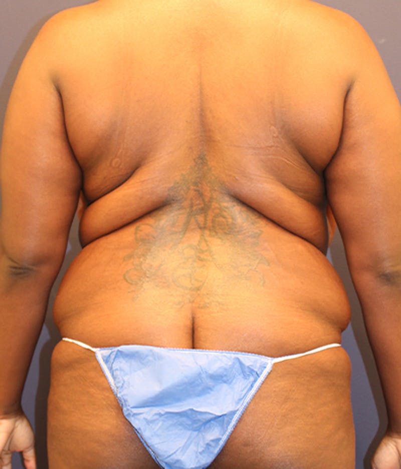 Liposuction Before & After Gallery - Patient 174164511 - Image 1