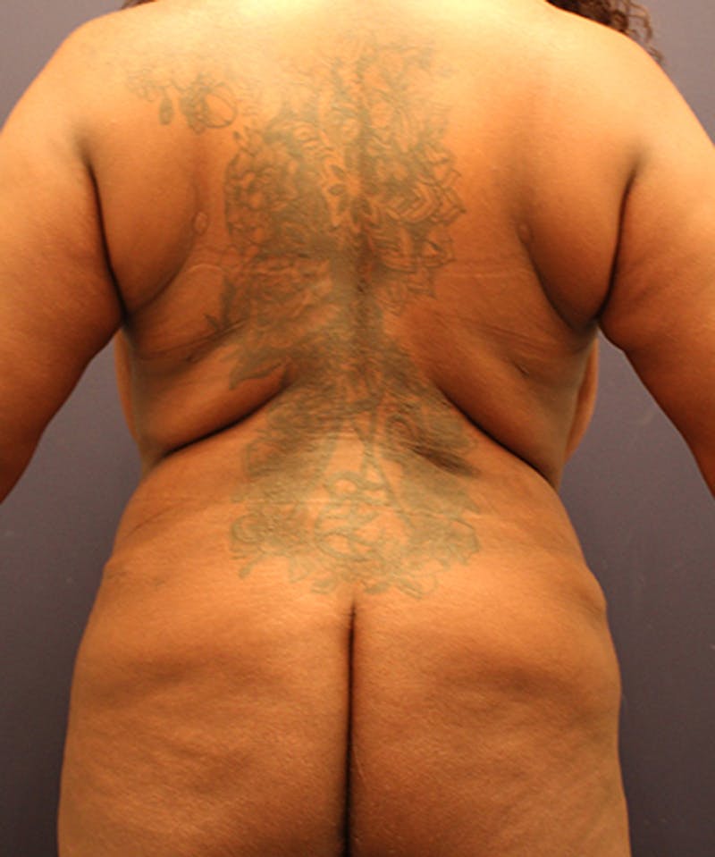 Liposuction Before & After Gallery - Patient 174164511 - Image 2