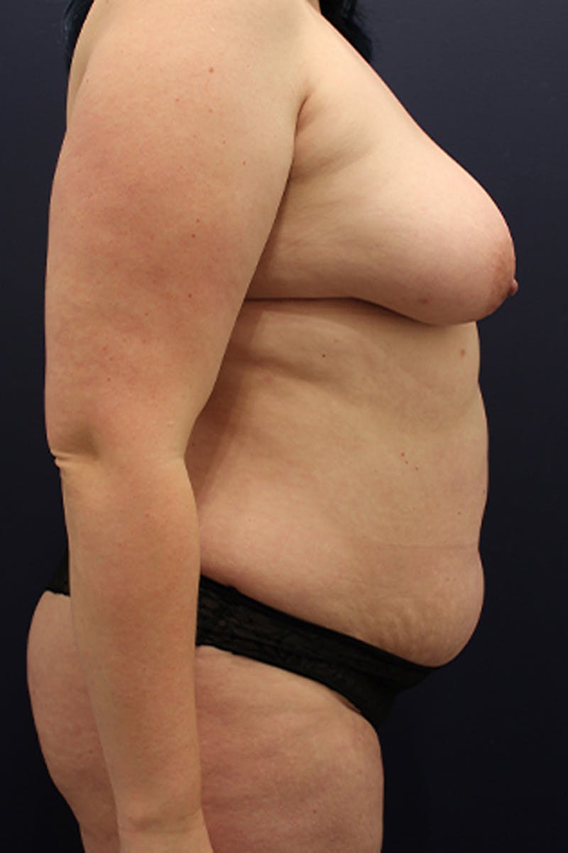 Liposuction Before & After Gallery - Patient 174164513 - Image 3