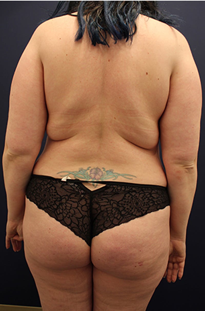 Liposuction Before & After Gallery - Patient 174164513 - Image 5