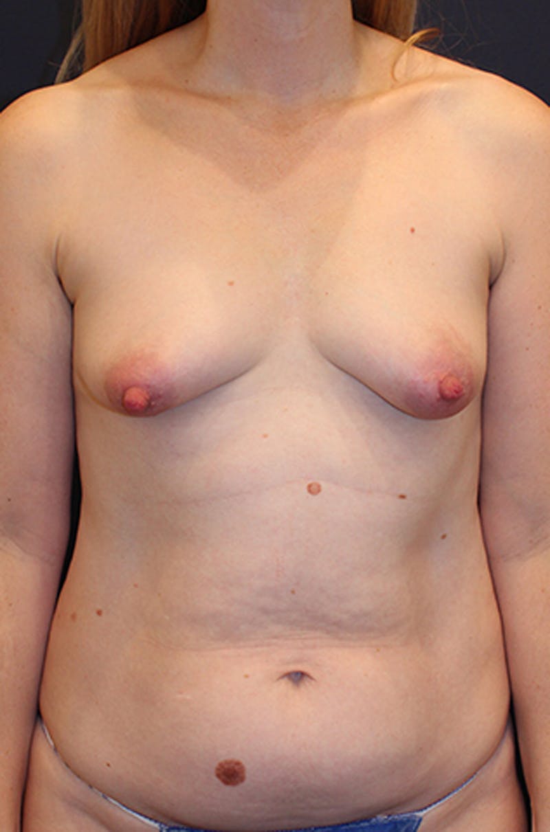 Liposuction Before & After Gallery - Patient 174199604 - Image 1