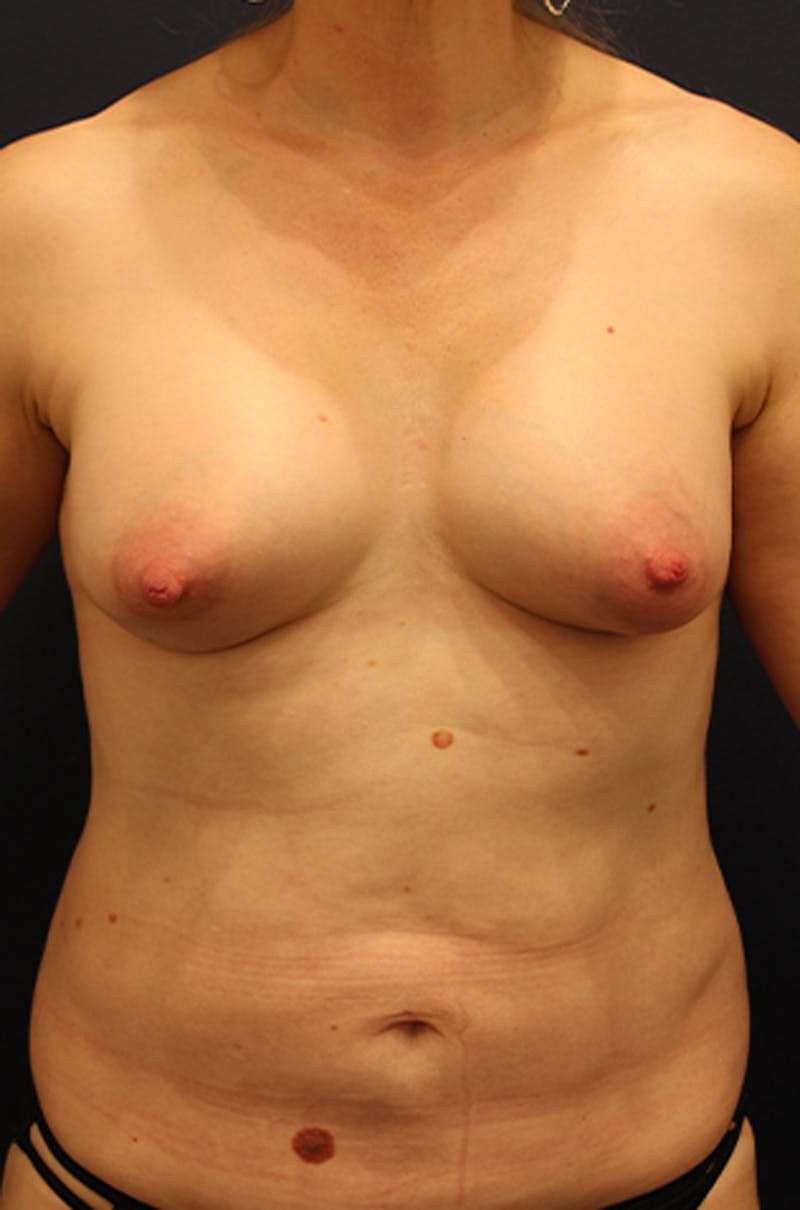 Liposuction Before & After Gallery - Patient 174199604 - Image 2