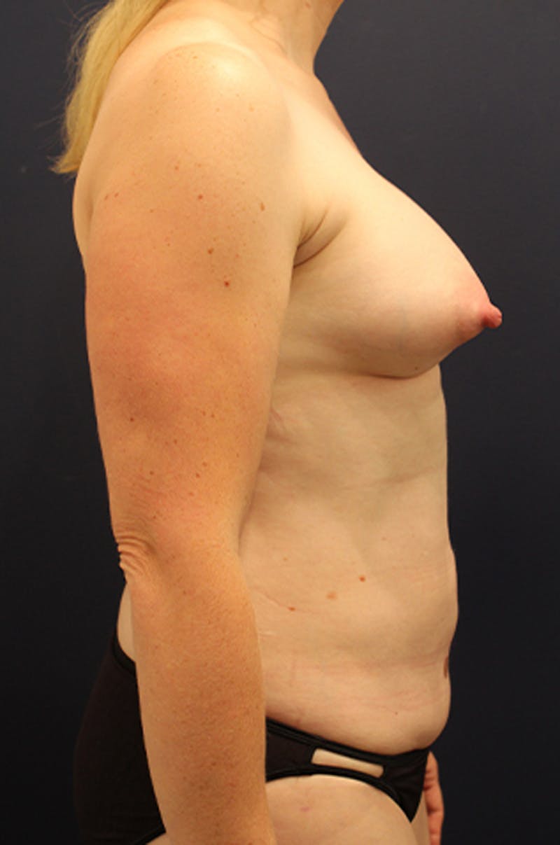 Liposuction Before & After Gallery - Patient 174199604 - Image 6