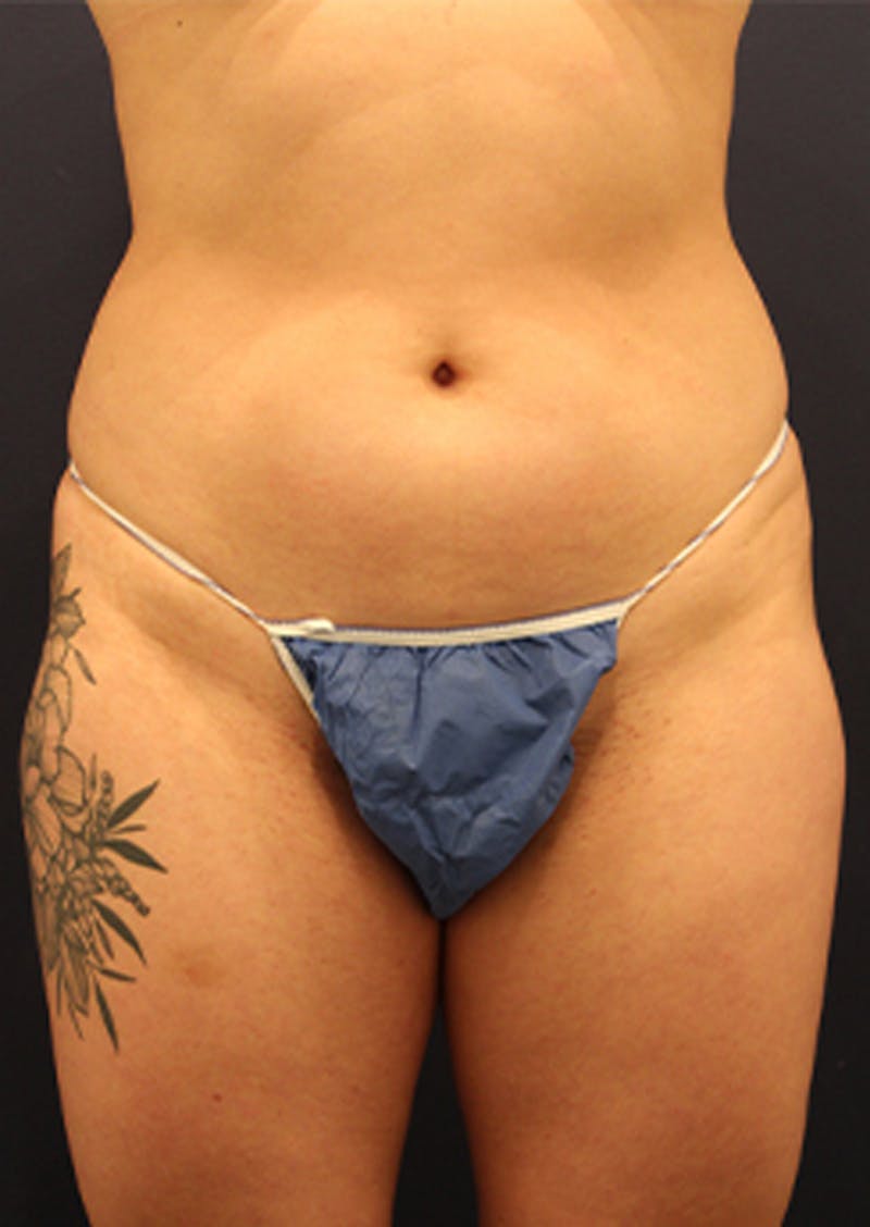 Liposuction Before & After Gallery - Patient 174199605 - Image 1