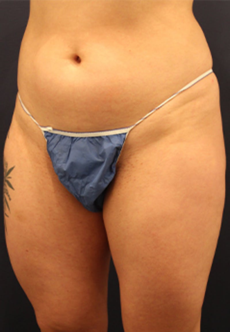 Liposuction Before & After Gallery - Patient 174199605 - Image 2