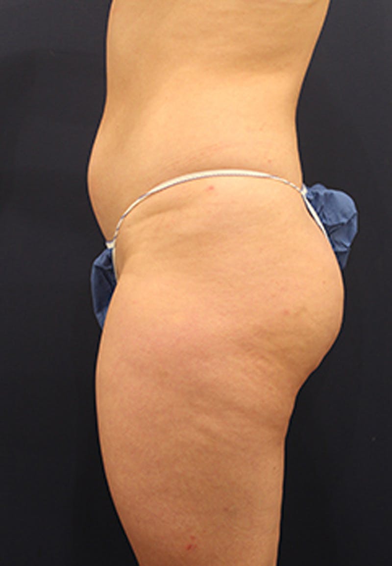 Liposuction Before & After Gallery - Patient 174199605 - Image 3