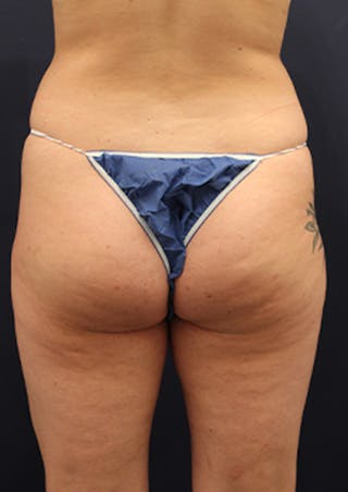 Liposuction Before & After Gallery - Patient 174199605 - Image 4